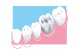 ZAHNMEDIZIN (Abb. 2g, h). Daher sollte durch ein In-Office-Bleaching eine gleichmäßige Zahnfarbe erreicht werden.