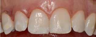3 e: Nach 3 Monaten Zahn 13 imponiert weiterhin recht deutlich, die anderen infiltrierten Zähne (21-12 sowie 33+32) sind als