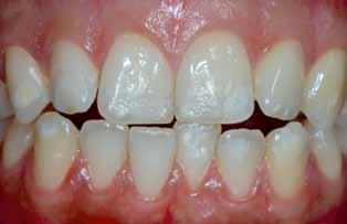Infiltration erbrachte befriedigendes Ergebnis an den Zähnen 21-12, während 13 nur wenig maskiert erscheint. Abb. 3 f u.