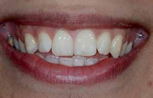 Die Abschlussbilder nach 2 Stunden zeigen die hierdurch erreichte wesentliche optische Verbesserung an den beiden Zähnen.
