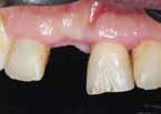 Das Durchtrittsprofil auf der Zahnfleischmaske wird mit dem apikalen Teil des Abformabutments vorgeformt (Abb.
