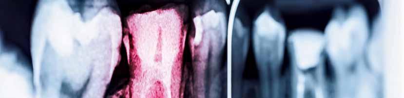 DENTALFORUM Nichtchirurgische Revisionsbehandlung Mithilfe moderner Technik und Hilfsmittel ist es möglich, die Erfolgsrate endodontischer Revisionen zu erhöhen.