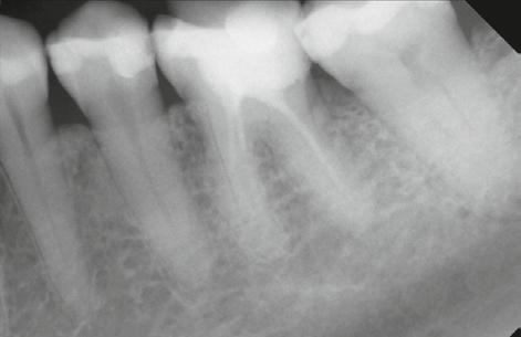 hypo-a Premium Orthomolekularia Fall 1 Eine 52-jährige Patientin wurde vom Hauszahnarzt mit der Bitte überwiesen, vor geplanter prothetischer Versorgung eine endodontische Revisionstherapie am Zahn