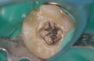 Die endodontische Diagnose lautete: Pulpastatus: pulpless and infected; periapikaler Status: symptomatic apical periodontitis.