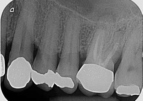 DENTALFORUM Fall 2 Ein 54-jähriger Patient wurde vom Hauszahnarzt mit der Bitte überwiesen, vor geplanter prothetischer Neuversorgung eine endodontische Revisionstherapie am Zahn 26 durchzuführen