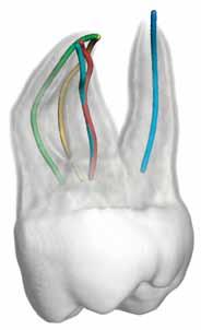 DENTALFORUM Fünf virtuelle Schritte für eine sichere und erfolgreiche endodontische Behandlung Die 3D Endo-Software von Dentsply Sirona ist eine DVT-basierte Software zur Verbesserung der Planung und
