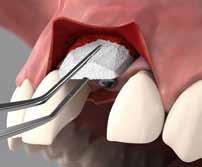 FIRMENNACHRICHTEN Neuausrichtung der Implantat-Aktivitäten von Dentsply Sirona Im Oktober 2016 hatte Dentsply Sirona bekannt gegeben, nach der Fusion das Deutschlandgeschäft für optimalen