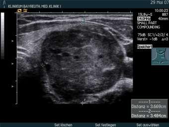 ½ kleiner als 5mm Reiners C Thyroid gland ultrasound screening (Papillon Initiative).