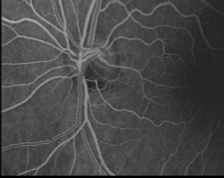 Altitudinal visual field asymmetry is coupled with altered retinal