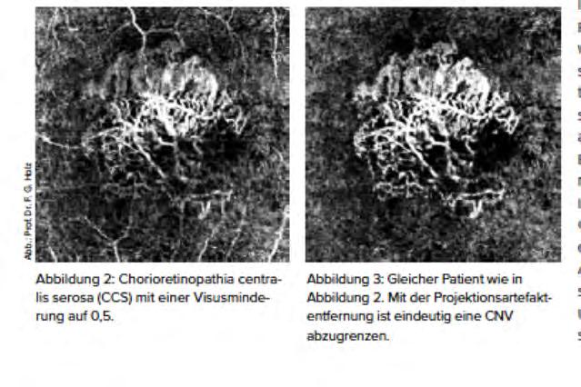 Neue Diagnostikmöglichkeiten mittels OCT Angiographie - Auflösung transversal 5,7 µm/ axial 3,9 µm Was ist normal? Neu zu definieren z.b.