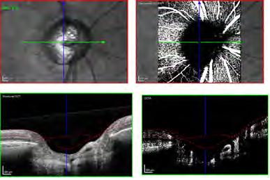Choriodea/ Lamina cribrosa Imaging OCT Angiography: Eds: