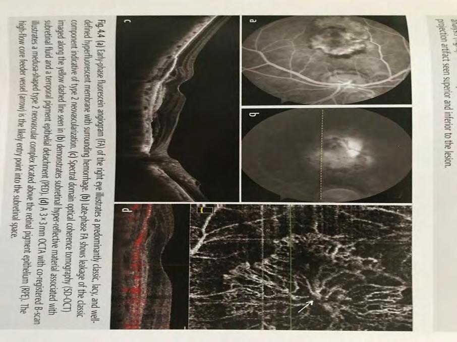 OCT Angiography: Eds: D.R Chow, P. R.