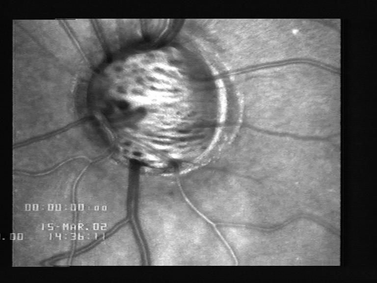 Optic nerve head non perfusion is a common finding in COAG. G.