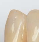 Die Dentinkern-Gerüste werden nach Fertigung durch BEGO Medical anschließend mit einer individuellen Schneideschichtung versehen.