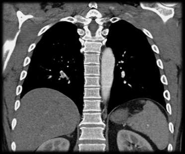 - massive Thromben auf Schrittmachersonden - flottierender Thrombus in A.