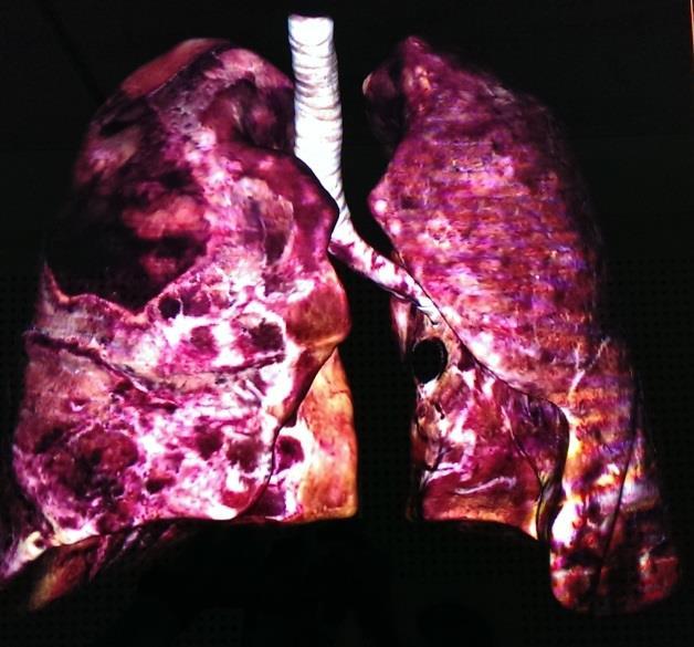 Zur einzelnen Darstellung der Lunge empfiehlt es sich zum Preset 5 zu wechseln.