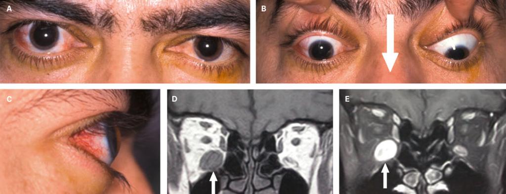 Magnetresonanztomographie: Homogene Infiltration des unteren geraden Augenmuskels (D, Pfeil), die sich mit Gadolinium anreichert (E, Pfeil).