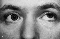 100 3 Periphere Augenbewegungsstörungen Tendosynovitis, Adhäsionen, tumoröse Infiltration des M. obliquus superior, Einklemmung des M. obliquus superior in einer Orbitadachfraktur.
