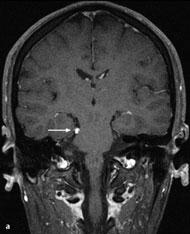 trochlearis nicht zu erwarten und nur bei großen Neurinomen mit Hirnstammkompression zu erwägen.