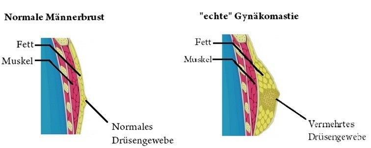 Definition Ein- oder doppelseitige Vergrößerung der männlichen Brustdrüse durch Vermehrung des Drüsenkörpers (γυνή (gynä) = Frau und μαστός (mastos) = Brust) Die