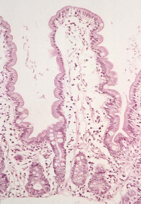 546 Farbteil Abb. 7.3. Schistosomiasis: Rektumschleimhaut ohne Entzündung, aber mit einem Granulom in der Submukosa.