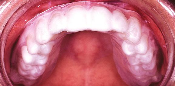 In den ersten ein bis zwei Tagen nach der Bleichung wird der Zahn alleine durch den Wasserentzug beim Bleichen heller. Das Bleichergebnis kann somit erst am 3.