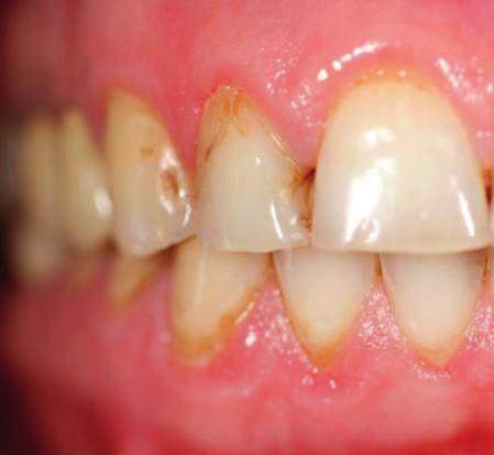 Auch können sich erneut Farbstoffe an oder in die Zähne einlagern.