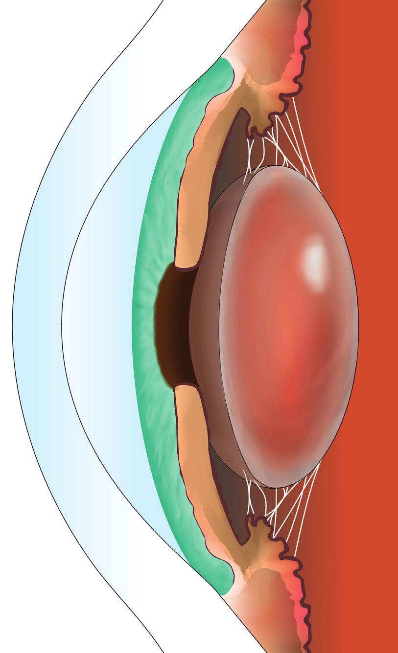 Hornhaut Regenbogenhaut (Iris) Augenvorderkammer