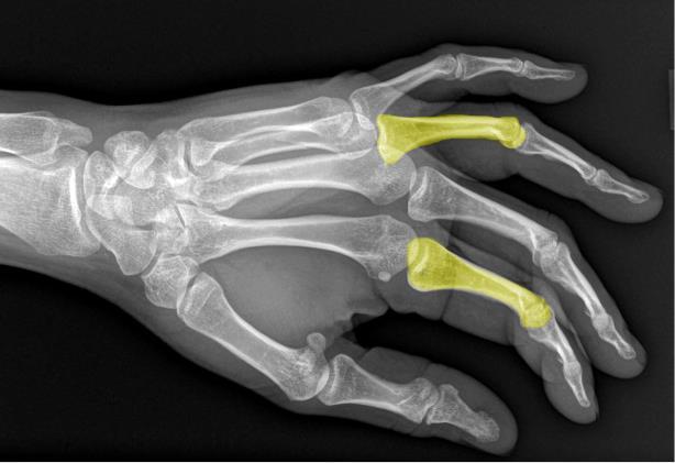 verbindenden Gelenken. Frakturen des Fingergrundglieds entstehen durch gewaltsame Fingerbewegung, meist durch eine Verdrehung des Fingers.