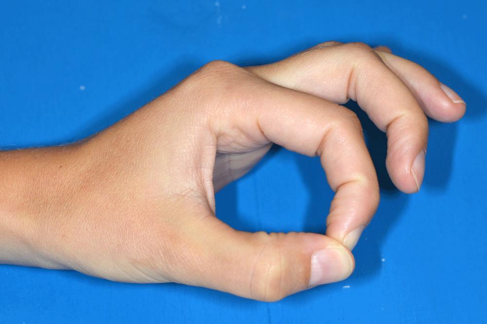 Auch ist eine Beteiligung des Grundgelenks (Zwischen Mittelhand und Fingergrundglied) oder des Mittelgelenks (Zwischen Fingergrundglied und Mittelglied) möglich.