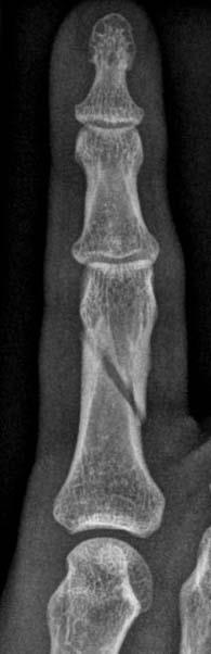 Nach Brüchen des Fingergrundglieds kann es durch Verklebungen mit der über den Knochen laufenden Strecksehne ( Streckaponeurose ) zu einer Bewegungseinschränkung kommen.