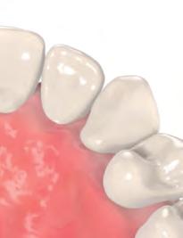 Entfernen Sie zunächst Zahnstein mit einem Ultraschallgerät (Polierpasten sind