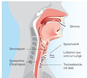 Tracheotomie Indikationen zur Tracheotomie Freihalten der Atemwege Akut: Glottis- oder Larynxödem