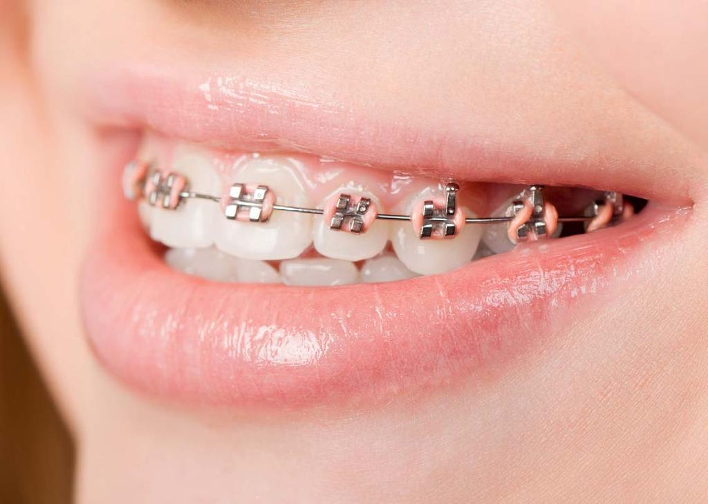 Gesundheit Foto: Draw05/Shutterstock TEST Zahnspangenmaterialien Auf den Zahn gefühlt Im Mund vieler Zahnspangenträger stecken Stoffe wie Nickel oder Latex, die Allergiker vermeiden sollten.