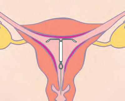 Die Hormonspirale kann je nach Wunsch der Frau bis zu 5 Jahre in der Gebärmutter belassen werden, wo sie ununterbrochen wirkt.