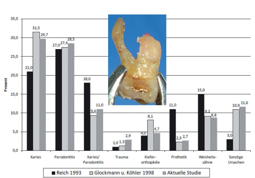 55 Abb. 6: Ursachen des Zahnverlustes in Deutschland nach Angaben der behandelnden Zahnärzte zwischen 1993 und 2011 (Reich und Hiller, 1993, und Glockmann et al.