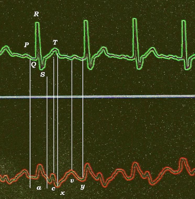 Venenpulskurve Beziehung zwischen EKG- und ZVD-Kurve (HF 70/min