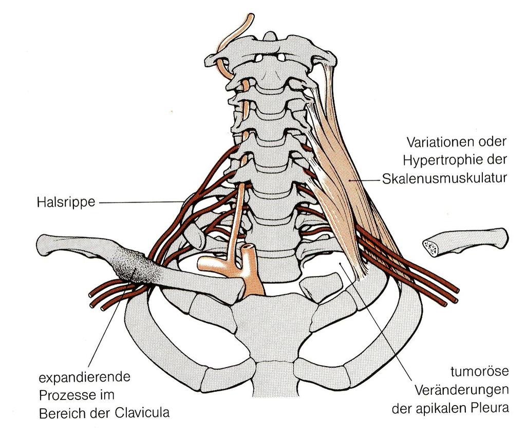 Thoracic outlet syndrom (TOS) Im Bereich des Halses besteht ein räumliche Nähe der Muskelgruppe der Skaleni und des kleinen Brustmuskels, des Armplexus, der 1. + 2.