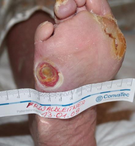 Faktoren, welche die Entstehung einer Entzündung im Bereich des Fußes (Fußulkus) begünstigen 1. Schlechte Diabeteseinstellung (HbA1c) 2. Vorbestehende Ulcera oder Amputation 3.
