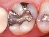Insuffiziente Amalgamfüllung an Zahn
