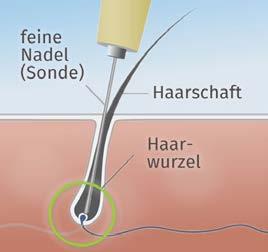 Durch einen hochfrequenten Stromimpuls wird die Haarwurzel verödet.