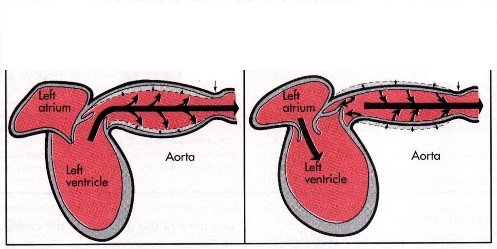 Elastizitätverlust der Aorta und Blutdruck