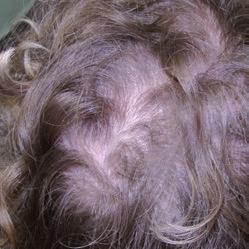 **Rep-Hair kontrollierte Studien: 4 Monate ausgeführt unter Verwendung Rep-Hair