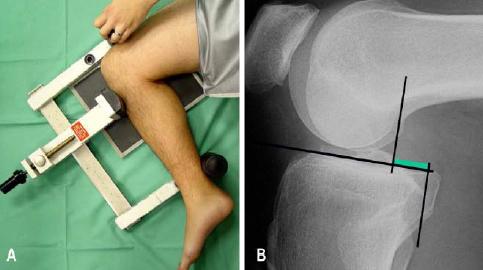 gesunden Knie stimmen die Schnittpunkte auf der Transversalebene überein und die Differenz beträgt 0 mm.