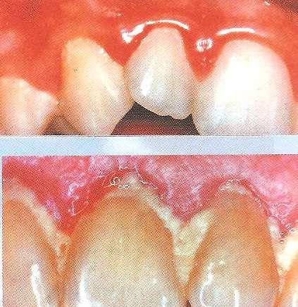SYMPTOME : Zahnfleischbluten