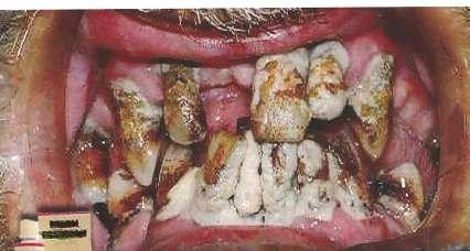 Risikofaktoren : Zahnhygiene Ernährung Genetische Disposition (IL 1) Tabakkonsum Diabetes