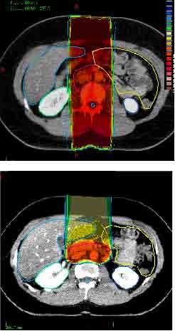 Anwendungsbeispiele: Tumortherapie mit Hadronen Vorteil gegenüber Bestrahlung mit