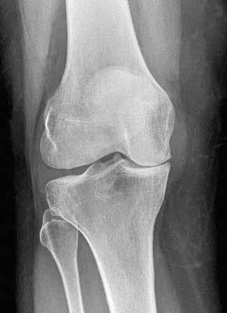 SYMPTOME Seit einiger Zeit wissen Sie, dass mit Ihrem Knie etwas nicht stimmt. Sei es nach einer früheren Verletzung oder einer Arthrose aus unbekannten Gründen treten Schmerzen auf.
