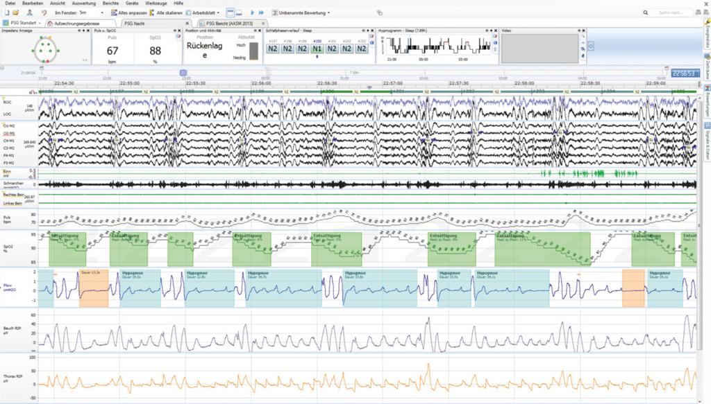 Übersichtsartikel AIM 484 Abbildung 1: Polysomnographie: 5-Minuten-Ausschnitt mit 2 Apnoen, fehlenden Atemdruckschwankungen (orange), 8 Hypopnoen (blau), gemessen mit nasalen Kanülen,