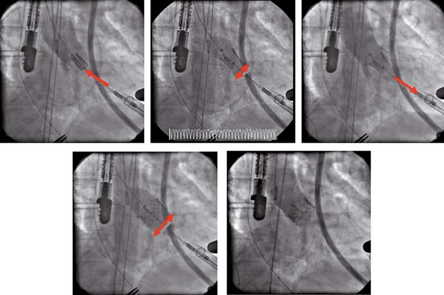 Abbildung 5. Schrittweise Klappenimplantation. Figure 5. Stepwise valve deployment.
